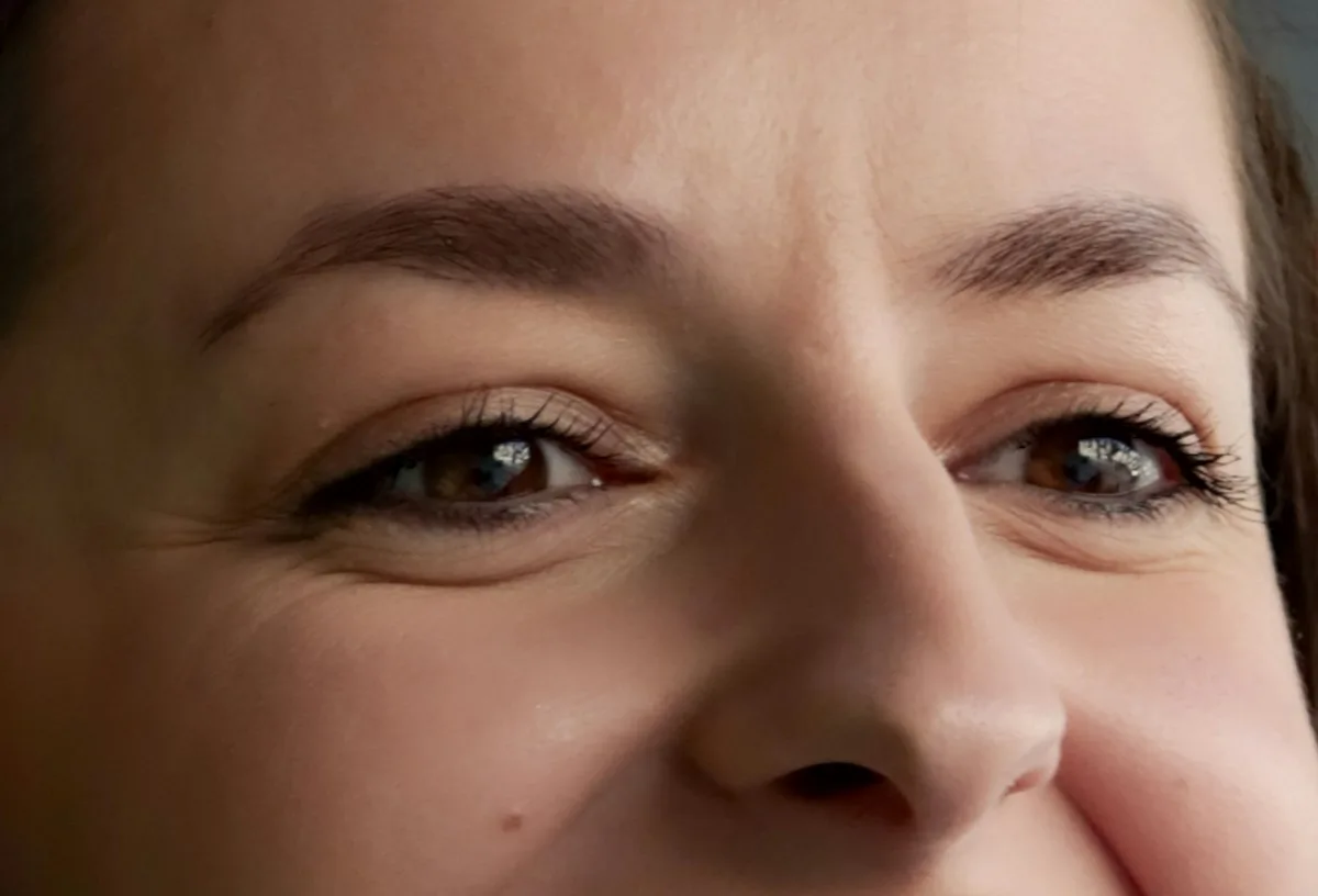 Can Liposuction Tighten Skin?