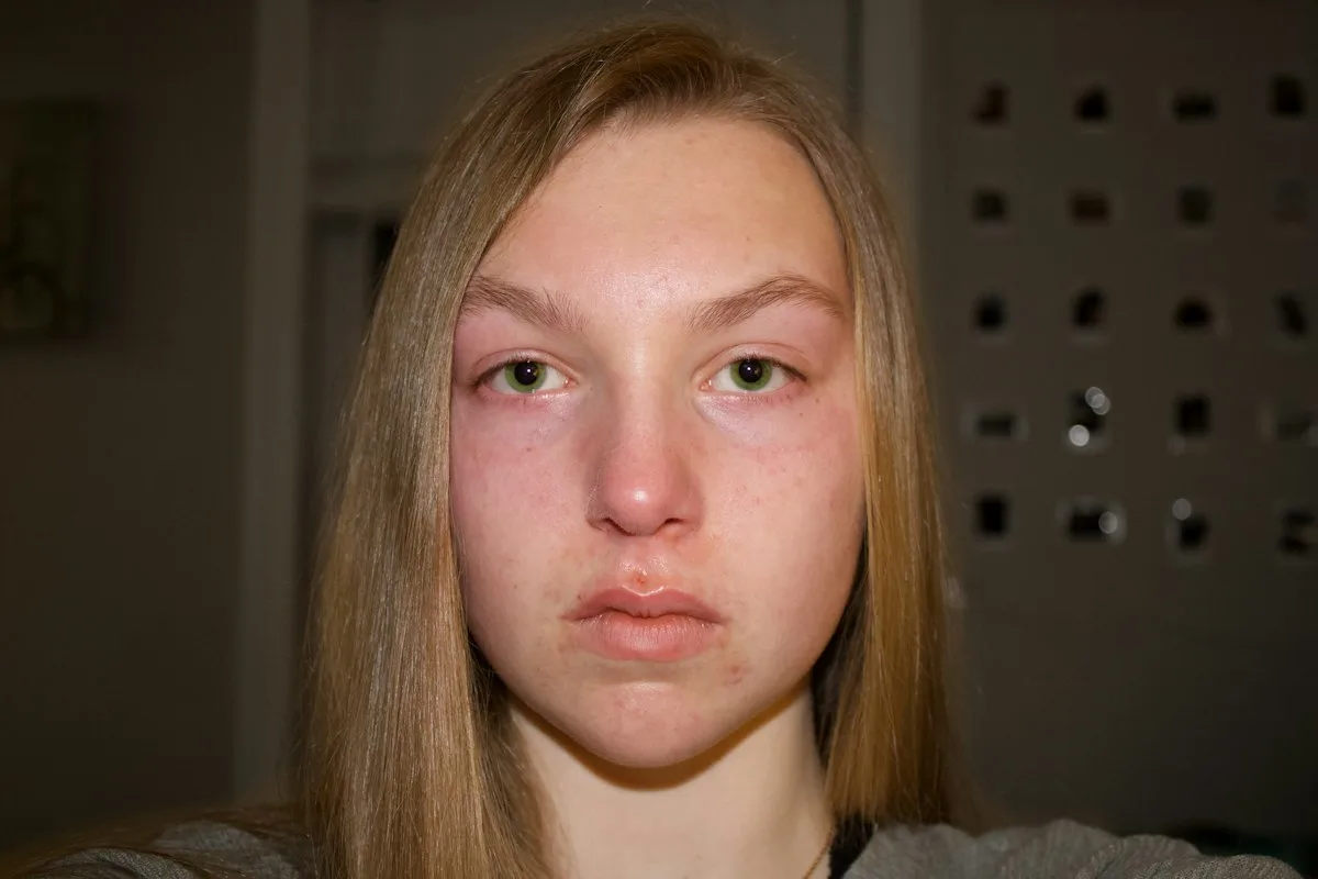 facelift-for-men