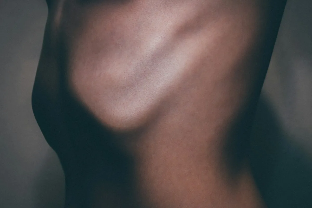 liposuction-and-obesity