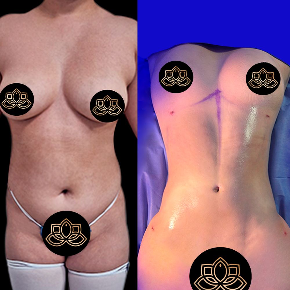 Benefits of Liposuction 360 for Full-Body Contouring in Tijuana
