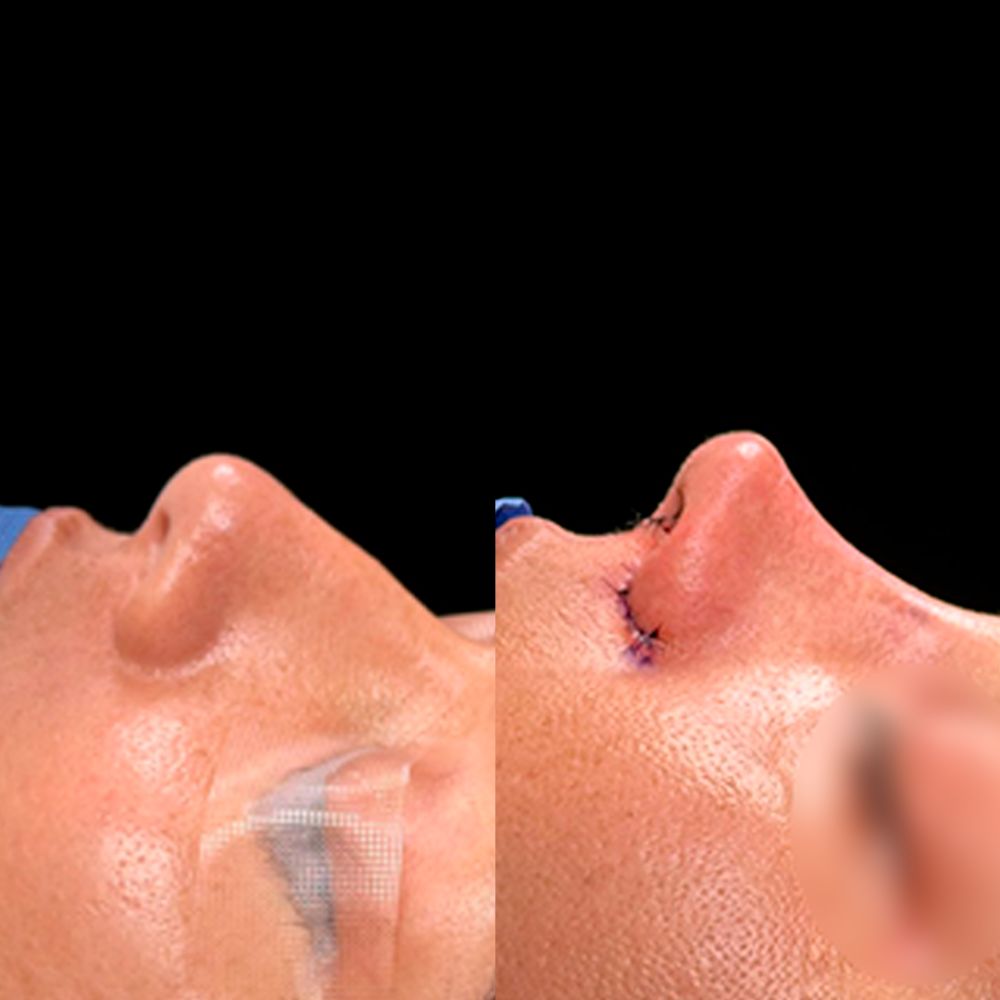 What Happens During a Rhinoplasty Procedure?