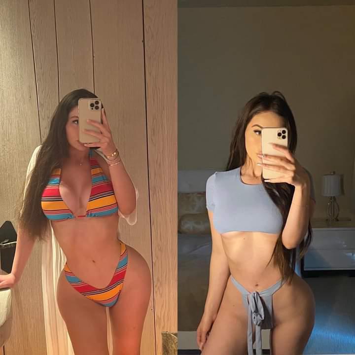 Real patient before and after Brazilian Butt Lift (BBL) and liposuction at Vive Plastic Surgery Tijuana