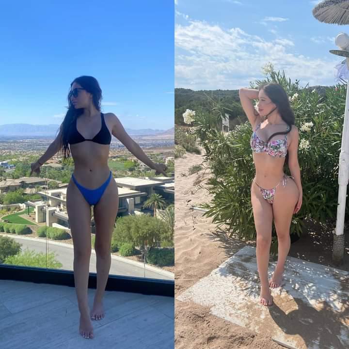 Real patient before and after Brazilian Butt Lift (BBL) and Lipo 360 at Vive Plastic Surgery Tijuana