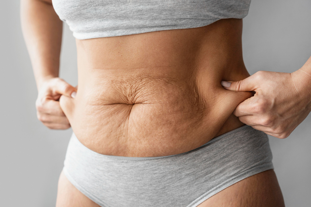 How a Tummy Tuck Can Help After Pregnancy or Weight Loss