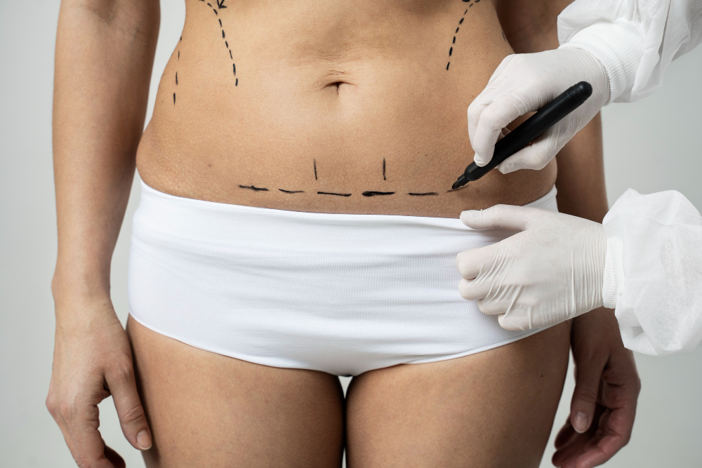 Tummy Tuck Scars: What to Expect and How to Minimize Them