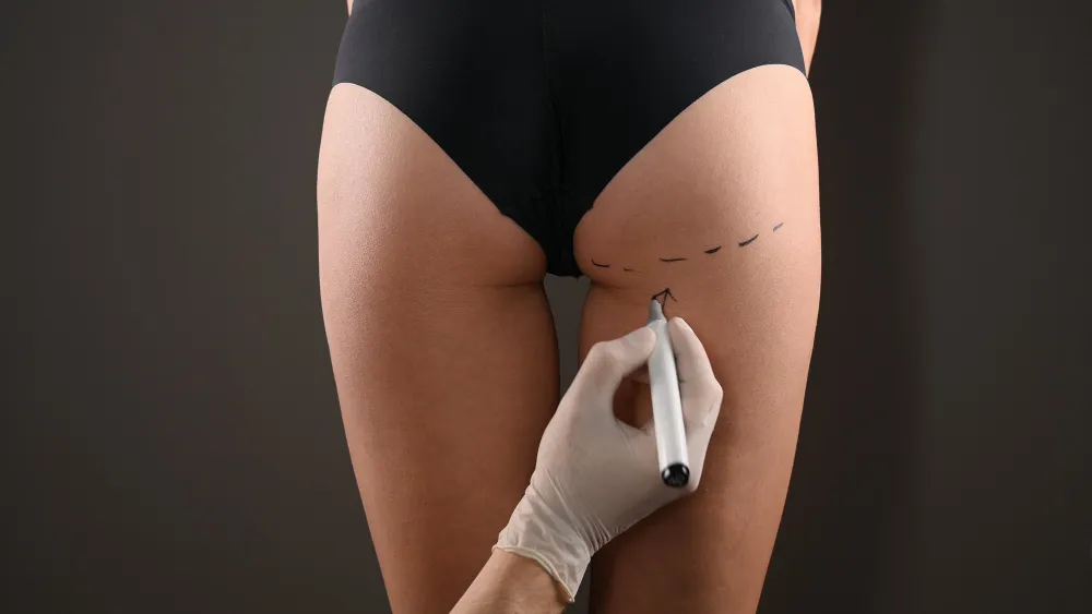 Who’s a Good Candidate for Gluteal Implants?
