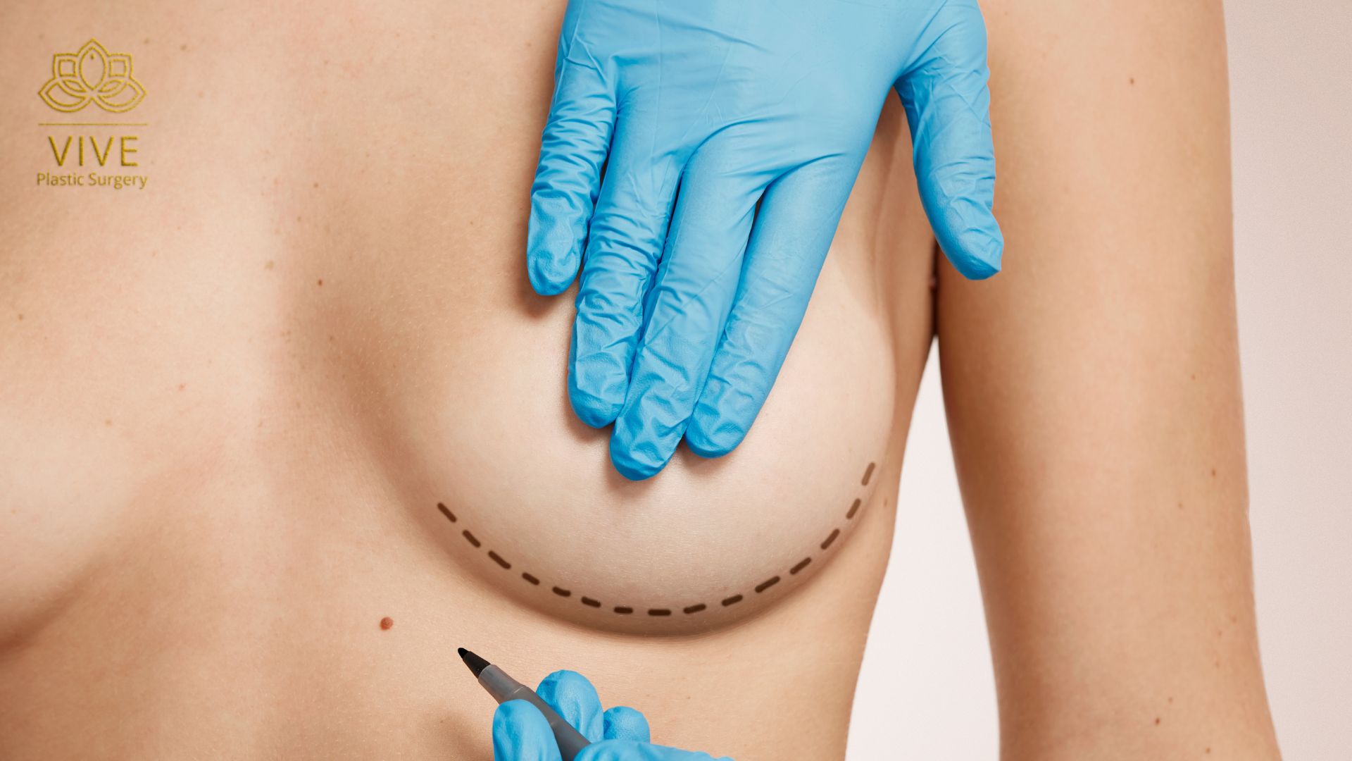 Understanding Breast Implants Placement Options