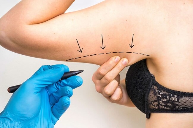 Plastic surgeon marking upper arm for brachioplasty procedure in Tijuana – Vive Plastic Surgery