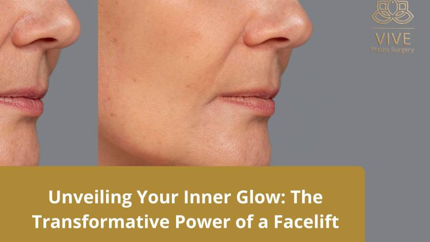 Before and after results of facelift procedure showing smoother jawline and youthful skin at Vive Plastic Surgery in Tijuana