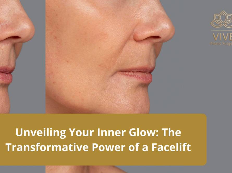 Before and after results of facelift procedure showing smoother jawline and youthful skin at Vive Plastic Surgery in Tijuana