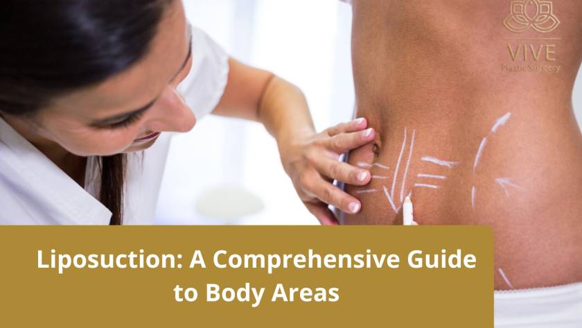 A doctor marking a patient's abdomen with white lines, indicating targeted areas for liposuction and body contouring.