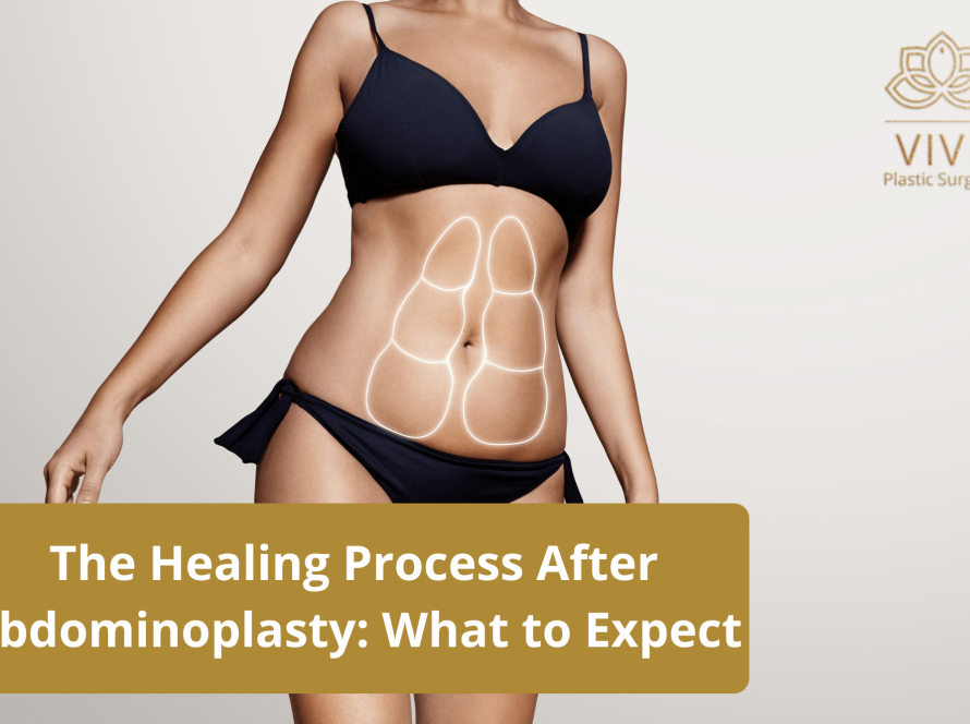 Woman showing abdominal contouring lines, illustrating the healing process after abdominoplasty at VIVE Plastic Surgery in Tijuana.