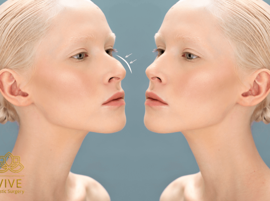 Before and after rhinoplasty comparison showing nose reshaping in Tijuana
