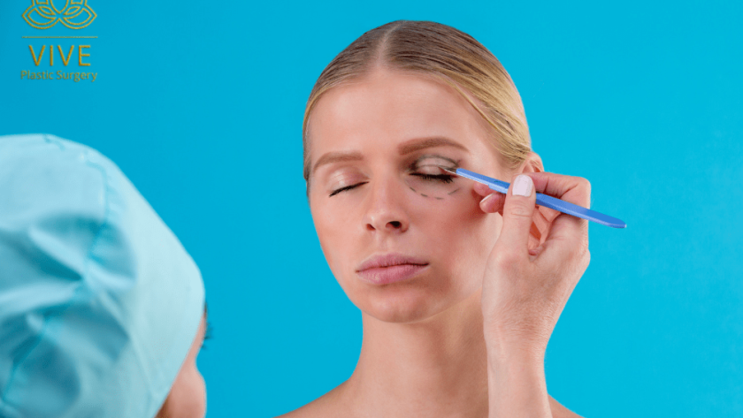 Woman preparing for blepharoplasty with eyelid surgery markings in Tijuana