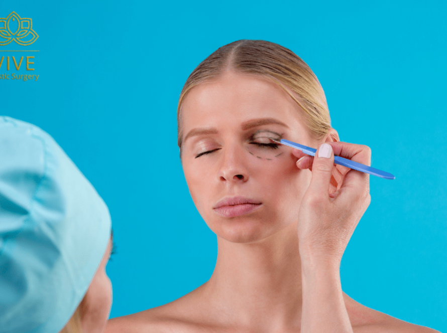 Woman preparing for blepharoplasty with eyelid surgery markings in Tijuana