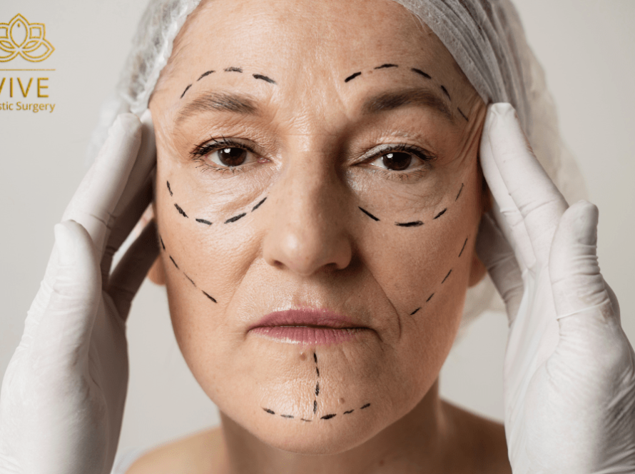 Mature woman with facial surgery markings preparing for facelift in Tijuana