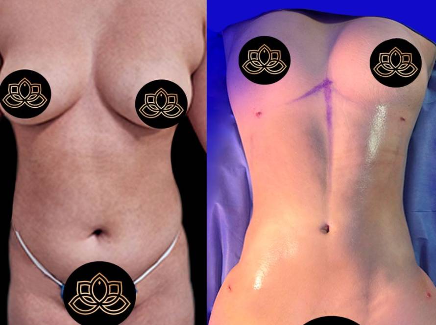 Female liposuction before and after results in Tijuana