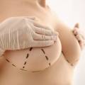 How Long Do Breast Implants Last?
