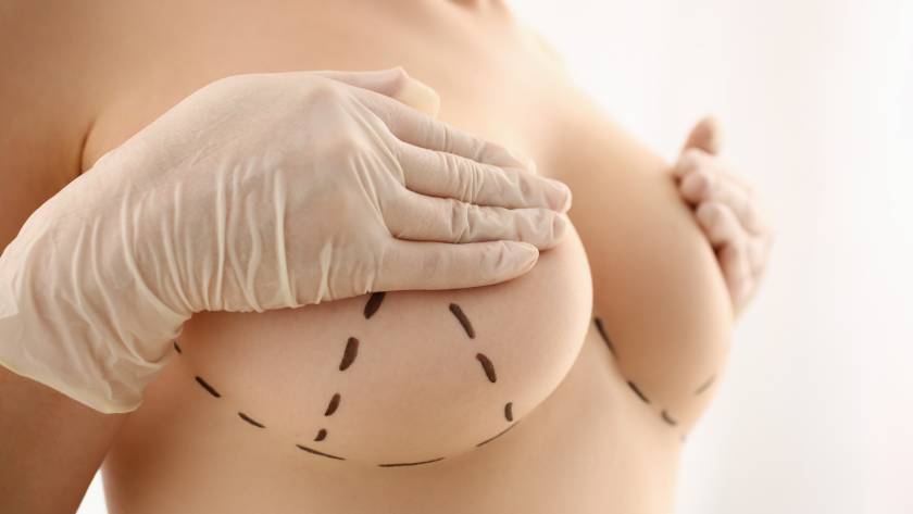 Breast augmentation markings before surgery in Tijuana