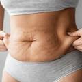 How a Tummy Tuck Can Help After Pregnancy or Weight Loss