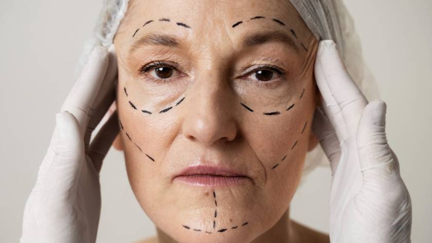 Mature woman with facial surgery markings before facelift – catalog image, not a real patient