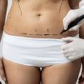 Tummy Tuck Scars: What to Expect and How to Minimize Them