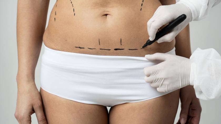 Surgeon marking abdomen before tummy tuck surgery – catalog image, not a real patient