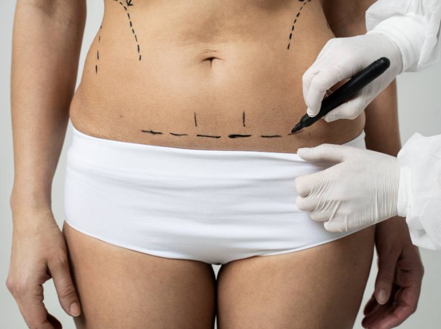 Surgeon marking abdomen before tummy tuck surgery – catalog image, not a real patient