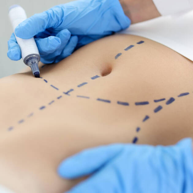 Surgeon marking abdomen before liposuction procedure in Tijuana