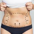 When Is It Safe to Consider Cosmetic Surgery After Childbirth?