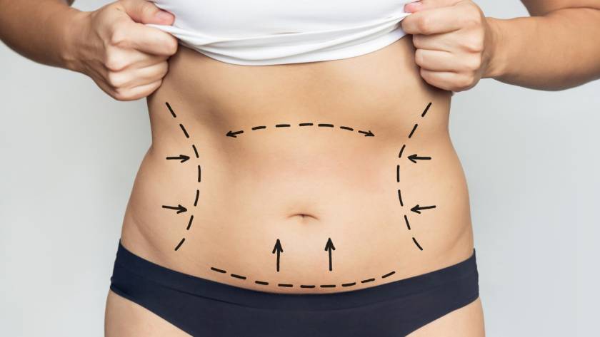 Abdominal liposuction and tummy tuck markings illustration
