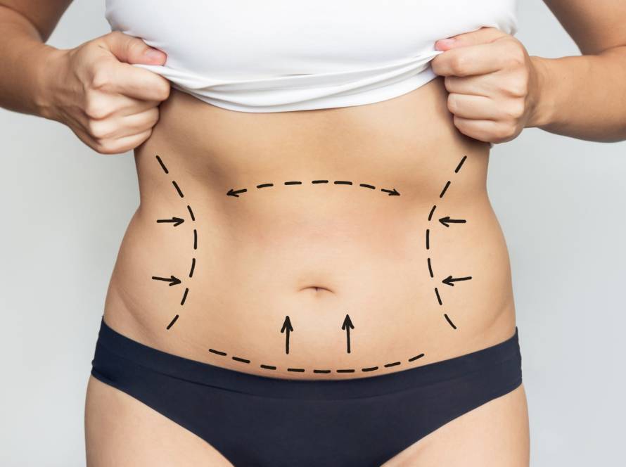 Abdominal liposuction and tummy tuck markings illustration