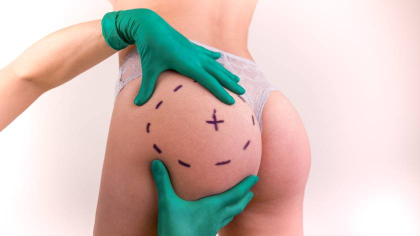 Surgeon marking area for Brazilian Butt Lift (BBL) procedure in Tijuana