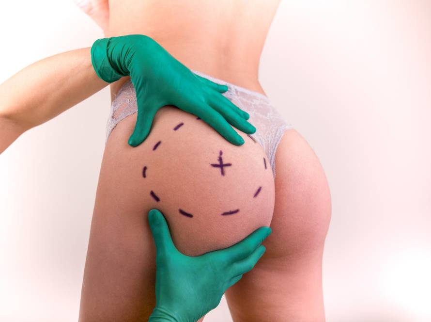 Surgeon marking area for Brazilian Butt Lift (BBL) procedure in Tijuana