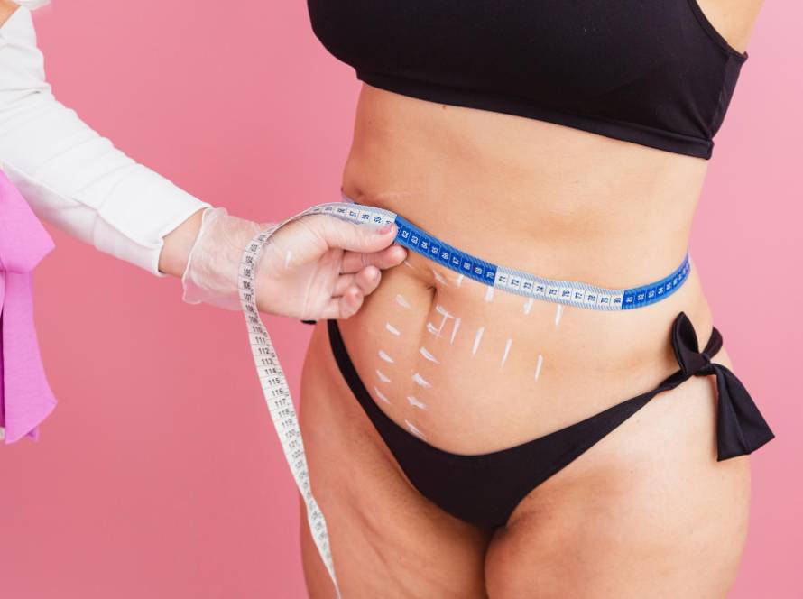 Woman measuring waist before liposuction surgery in Tijuana