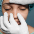 How Long Does It Take to See Final Rhinoplasty Results?