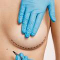 Understanding Breast Implants Placement Options